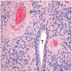 A 37 year old man had suffered from hemiplegia for several years.He had been told it was multiple sclerosis.A neurologist suspected that the diagnosis was incorrect,and ordered a CT scan of the patient's cervical spine.The scan revealed a central tumour,which was pressing on the corticospinal tract.A neurosurgeon was able to completely remove the tumour,which is shown in the accompanying photomicrograph.Which one of the following is the best diagnosis?   A) Ependymoma B) Glioblastoma C) Meningioma D) Multiple sclerosis E) Oligodendroglioma