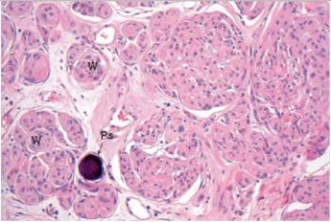 A 47 year old woman consulted her physician because of frequent headaches and weakness in her left arm.A CT scan showed a large 4 cm tumour on the right convexity,attached to the dura.It compressed,but did not invade the motor cortex.The tumour was easily removed.A representative section from the tumour is shown in the accompanying photomicrograph.Which one of the following is the best diagnosis?   A) Ependymoma B) Glioblastoma C) Meningioma D) Multiple sclerosis E) Oligodendroglioma
