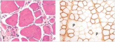 A 3 year old child was having difficulty walking.He had not met his developmental milestones.His legs actually looked quite strong,with apparently muscular calves.However,the paediatric neurologist ordered a muscle biopsy,which is shown in the accompanying photomicrograph.On the right is an immunohistochemical stain for dystrophin protein.   A) Becker muscular dystrophy B) Duchenne muscular dystrophy C) Mitochondrial myopathy D) Neurogenic muscular atrophy E) Polymyositis