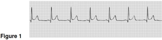   -The heart rate in Figure 1 is closest to A) 100. B) 70. C) 150. D) 50.