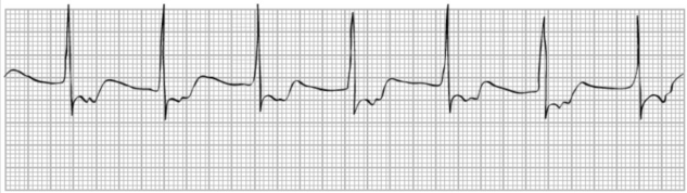 [solved] A Regular Rhythm Is One In Which The R-r Intervals | Quiz+