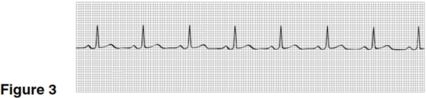 The rhythm in Figure 3 is   A) sinus tachycardia. B) sinus rhythm. C) sinus bradycardia. D) sinus arrhythmia.