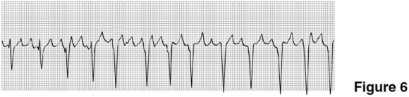 In Figure 6,the rhythm is   A) sinus rhythm. B) atrial fibrillation. C) atrial flutter. D) SVT.