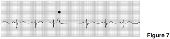 The rhythm in Figure 7 is   A) sinus rhythm with a sinus arrest and a junctional escape beat. B) sinus arrhythmia. C) sinus rhythm with a nonconducted PAC. D) wandering atrial pacemaker.
