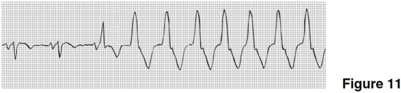 The rhythm in Figure 11 is   A) atrial fibrillation. B) atrial flutter. C) sinus rhythm with a burst of PAT. D) sinus rhythm converting to ventricular tachycardia.
