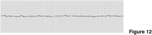   -In Figure 12,there are only A) P waves. B) QRS complexes. C) T waves. D) U waves.