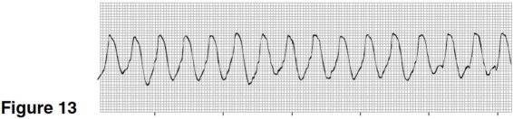 The rhythm in Figure 13 is   A) atrial flutter. B) ventricular fibrillation. C) atrial tachycardia. D) ventricular tachycardia.