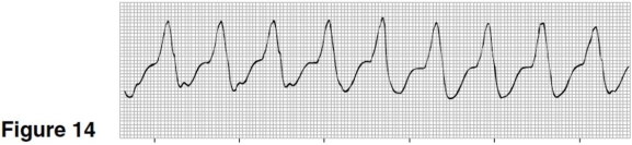   -The heart rate in Figure 14 is closest to A) 150. B) 100. C) 75. D) 60.