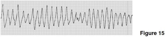 The rhythm in Figure 15 is   A) agonal rhythm. B) ventricular tachycardia. C) torsades de pointes. D) ventricular fibrillation.