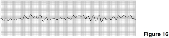   -Treatment for the rhythm in Figure 16 would include which of the following? A) Electrical shock to the heart B) Atropine C) Digitalis D) Oxygen removal
