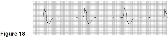   -The QRS interval in Figure 18 is closest to A) 0.12 seconds. B) 0.20 seconds. C) 0.32 seconds. D) 0.40 seconds.