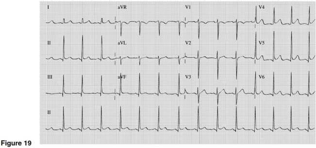   -There is evidence of which of the following in Figure 19? A) Slight ST segment elevation in multiple leads B) Significant Q waves in II,III,and aVF C) Inverted T waves in V₁-6 D) Widespread ST depression and T wave inversions
