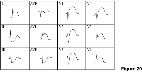   -The age of the MI in Figure 20 is A) acute. B) age indeterminate. C) old. D) impossible to tell.