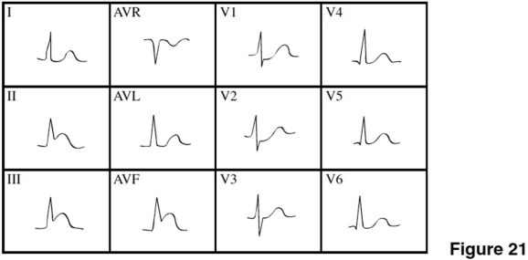  -The coronary artery that feeds blood to the damaged area of the heart in Figure 21 is the A) right coronary artery. B) left anterior descending. C) circumflex. D) popliteal.