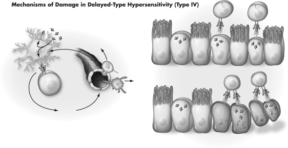 Using the figure below,please describe in detail how this type IV sensitivity is produced and how tissue is ultimately damaged.   