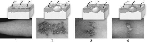 Which of the following displays a pus-filled raised lesion?   A)  1 B)  2 C)  3 D)  4