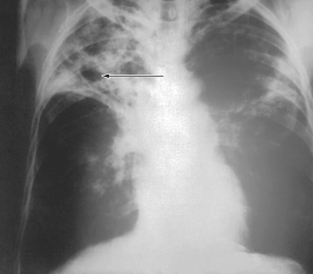 The Ghon complex shown in this figure is indicative of infection by   A)  Mycobacterium tuberculosis. B)  Bacillus anthracis. C)  Blastomyces dermatitidis. D)  Coccidioides immitis.