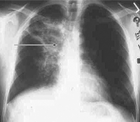 The diffuse infiltrate shown in this figure is indicative of   A)  pertussis. B)  blastomycosis. C)  tuberculosis. D)  pneumococcal pneumonia.