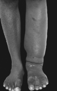 <strong>The swelling seen in this individual's leg is indicative of  </strong> A) cutaneous leishmaniasis. B) lymphatic filariasis. C) babesiosis. D) Chagas' disease. <div style=padding-top: 35px> 