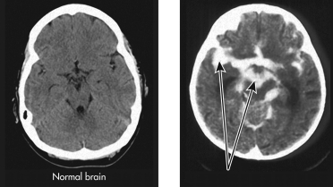 Refer to this image showing a CT scan of a brain displaying disease.To what does the arrow point?   A)  a brain abscess B)  encephalitis C)  myelitis D)  a normal brain