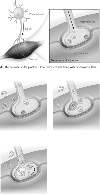 This figure shows the mechanism of action of botulinum toxin.Describe what is happening in each step.   