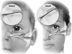 What is the significance of the anatomical difference shown?   A)  Adults are more prone to developing sinus infections. B)  Children are more prone to developing sinus infections. C)  Adults are more prone to developing middle ear infections. D)  Children are more prone to developing middle ear infections.