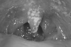 What is shown in this figure?   A)  a Candida albicans infection B)  dental caries C)  strep throat D)  a Streptococcus mutans infection