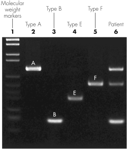 The image shown is a gel from a multiplex polymerase chain reaction (PCR) used to identify toxin genes in Clostridium botulinum.Why are there three lines associated with the patient shown?   A)  The patient is infected by three different species of bacteria. B)  Restriction fragments cut the patient DNA sample into three fragments. C)  The patient is infected by a strain of Clostridium botulinum that contains three toxin genes. D)  Molecular beacon probes are causing fluorescence of three regions.