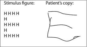 Here are a hierarchical letter figure and a copy of this stimulus drawn by a person with a unilateral brain injury. Where is the most probable location of this injury?   A) the right dorsolateral frontal lobe B) the left temporoparietal cortex C) the right fusiform gyrus D) the right occipital lobe