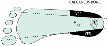 nurse is preparing to collect a capillary blood glucose specimen from a neonate.Which site is most appropriate for the nurse to use?   A) A (label on medial aspect of plantar surface of heel)  B) B (label on midposterior curvature directly over calcaneus)  C) C (label on ball of the foot)  D) D (label over arch of foot)  