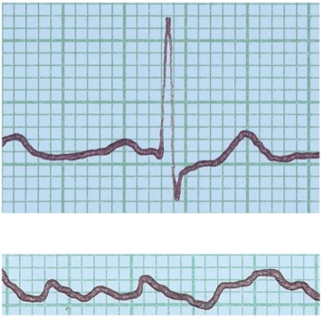 In the figure shown here, the top ECG shown is normal. What condition does the bottom ECG indicate?   A)  ventricular fibrillation B)  a heart murmur C)  hypertension D)  stroke E)  angina pectoris