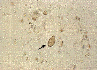 A woman who just returned from a trip to Southeast Asia has signs of biliary obstruction, which is confirmed by CT scan. Due to her recent travel history, the physician orders an ova and parasites examination before considering surgical intervention. The following element is found in her fecal sample at 400 <span class=