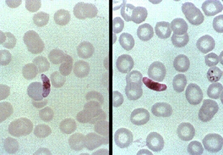 A recent emigrant from Somalia develops high fever, chills, and severe headache. Blood work on admission to the hospital reveals the following in his blood smear at 1000 <span class=