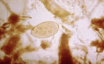 A farmer who raises sheep and cattle shows signs of jaundice. Along with elevated liver enzymes, he also has an elevated eosinophil count. A fecal sample for ova and parasites shows the parasite form seen below at 400 <span class=