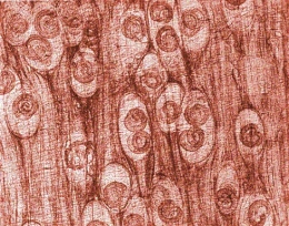 A patient with a history of eating wild game comes to the physician with a history of diarrhea over the past 3 weeks. In addition, he complains of fever, muscular pain and tenderness, headache, and general weakness. The patient also has a significant eosinophilia. A biopsy of a nodular area on his forearm is seen in the image below. This is consistent with a diagnosis of infection caused by   A)  Leishmania donovani. B)  Wuchereria bancrofti. C)  Trichinella spiralis. D)  Loa loa.