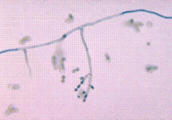 A graduate student returning from a month-long fieldwork experience in South America develops a dark nodular lesion on his left hand. Microscopic examination of the nodule reveals dark, coinlike inclusions. The following organism grows in culture. This organism is most likely   A)  Cladosporium spp. B)  Candida spp. C)  Coccidioides immitis. D)  Cryptococcus neoformans.