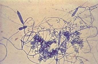 A patient with thickened and discolored nails was diagnosed with onychomycosis. A scraping of the nail was sent for culture. Microscopic analysis of the mold colony growth revealed the following morphology. The most likely identity of this organism is   A)  Microsporum canis. B)  Sporothrix schenckii. C)  Aspergillus fumigatus. D)  Trichophyton mentagrophytes.