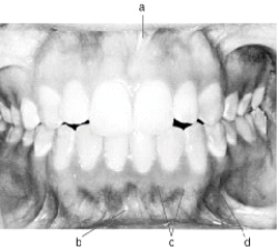 In the following illustration,structure  c  is the   A)  mucogingival junction B)  mandibular labial frenum C)  maxillary labial frenum D)  mucobuccal fold