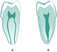 Which of the following best describes the root canal opening(s) in the figure  A  below?   A)  Accessory root canals B)  One main and one accessory root canal C)  Two apical root canals