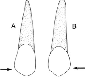 In the illustration below,figure  A  is a   A)  maxillary central incisor B)  maxillary lateral incisor C)  mandibular canine D)  maxillary canine