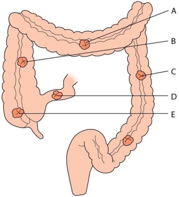<strong>The nurse is caring for a client with colorectal cancer who is postoperative from a transverse colostomy placement. What area of the bowel is involved? </strong> A)A B)B C)C D)D E)E