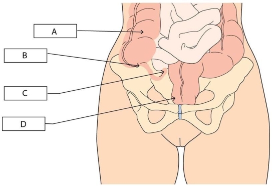   A nurse checking for tenderness at McBurney point for a client with suspected appendicitis will palpate which area? A) A B) B C) C D) D