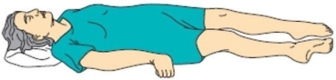 The nurse notices that a client who sustained a head injury from a motor vehicle crash begins to demonstrate an abnormal posture. (See image.) What does this posture suggest to the nurse about the client's brain functioning?   A) Improved level of consciousness B) Developing a seizure disorder C) Brainstem impairment D) Corticospinal tract impairment