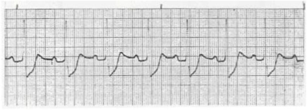A patient is admitted to the telemetry unit with new onset of weakness and fatigue. The following rhythm is now seen on the monitor, and the patient is now complaining of shortness of breath and mild chest discomfort. Which medication would be appropriate for this patient?   A)  Epinephrine 1 mg IV B)  Atropine 0.5 mg IV C)  Adenosine 6 mg IV D)  Amiodarone 300 mg IV