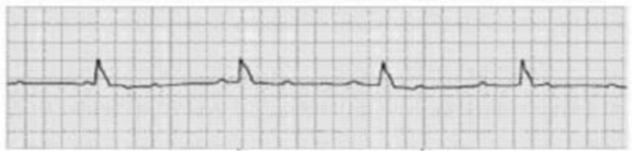 A patient has the following rhythm. Which assessment finding indicates a need for further treatment?   A)  Short period of asystole followed by conversion to normal sinus rhythm B)  Warm, dry skin C)  Heart rate of 88 and BP 124/80 D)  Heart rate of 42 and BP 78/60