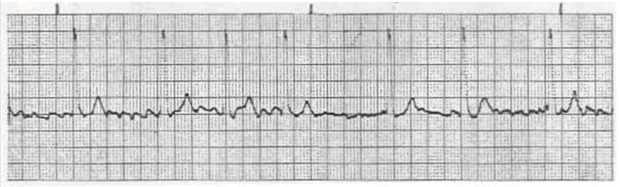 A patient complaining of  feeling tired  has the following cardiac rhythm. The patient has a history of an irregular heartbeat and current vital signs are BP 134/78; RR 17; SaO<sub>2</sub> 97% on room air. What should be done first for this patient?   A)  Perform a 12-lead ECG and compare it to previously recorded ECGs. B)  Prepare the patient for transcutaneous pacing. C)  Place the patient on 100% via nonrebreather mask. D)  Give Versed 1 mg IVP.