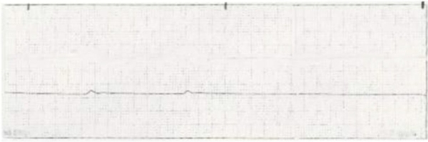 CPR is started on a patient who has developed ventricular fibrillation. The patient is defibrillated once with the resulting rhythm. Which intervention should the nurse implement next?   A)  Defibrillate the patient with 360 joules. B)  Administer atropine 1 mg IV push and repeat every 3 minutes. C)  Infuse amiodarone 300 mg IV push slowly. D)  Administer epinephrine 1 mg IV push.