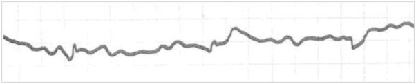 A patient has the following rhythm on the monitor. The patient is alert and oriented and denies any complaints at present. What should the nurse do first?   A)  Administer a precordial thump. B)  Check lead placement on the patient. C)  Begin CPR and call for a defibrillator. D)  Administer epinephrine 1 mg IV every 3 minutes.