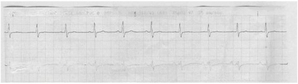 A patient experiencing pulseless ventricular tachycardia is defibrillated twice and has received medications according to ACLS protocol. The following rhythm is now present. What should the nurse do next?   A)  Continue monitoring and observing the patient for PVCs. B)  Place the patient on a maintenance lidocaine infusion. C)  Realize that the patient has been successfully converted to NSR. D)  Check the patient for a pulse and continue CPR if one is not present.