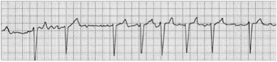A patient is experiencing a new onset of the following rhythm. With complications related to this rhythm in mind, which intervention is a priority?   A)  Monitor for sudden onset of ventricular tachycardia. B)  Perform neurologic checks every 4 hours. C)  Monitor for deterioration to third-degree block. D)  Assess skin turgor for dehydration.